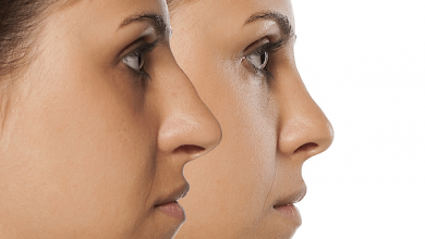 Photo of Improve the shape of your nose- rhinoplasty