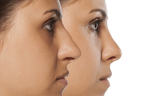 Rhinoplasty