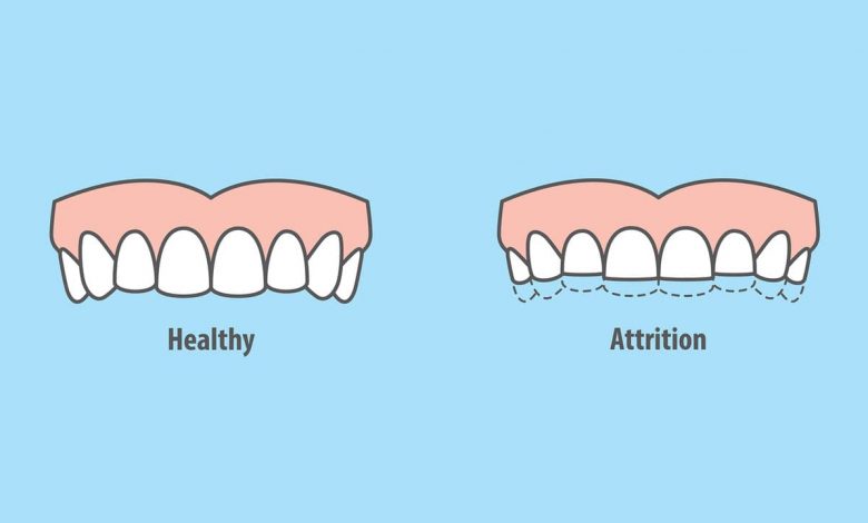 What Causes Teeth Clenching & Grinding?