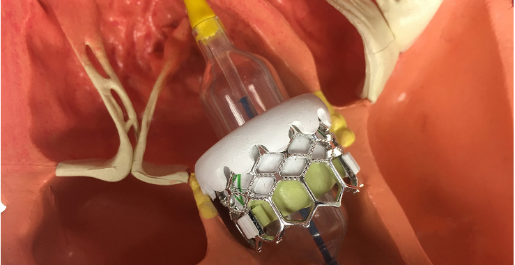 aortic_valve_replacement