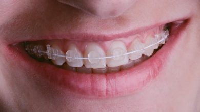 Photo of Do I Need Braces? A Brief Guide About Getting Braces
