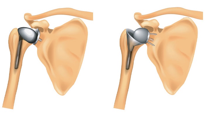 Joint Replacement