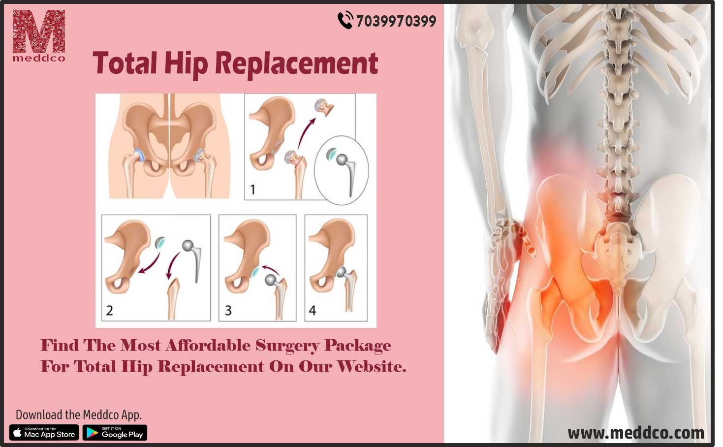 every-thing-you-need-to-know-about-total-hip-replacement-the-posting