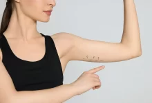 Photo of Arm Lift Surgery: Achieving Toned Arms through Sculpting